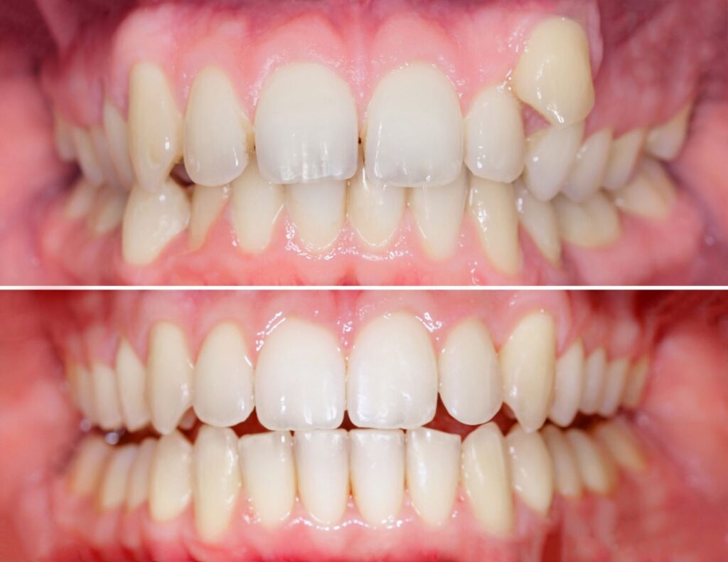 歯列矯正の一般的な期間とその変動要素