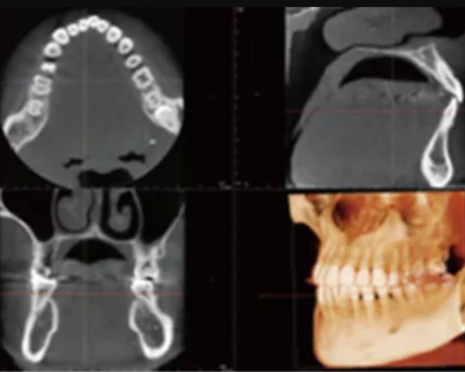 港区の審美歯科ピュアリオのマウスピース矯正の特徴2