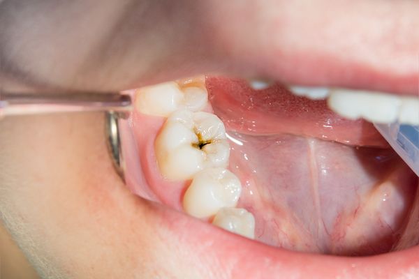 矯正治療中に虫歯が見つかったらいつ治すべき？