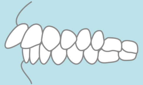 インビザラインは出っ歯の矯正に失敗する？
