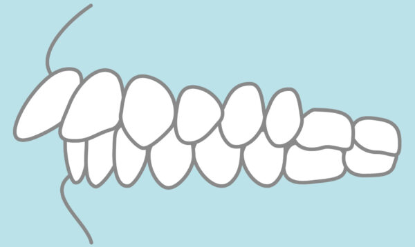 インビザラインは出っ歯の矯正に失敗する？