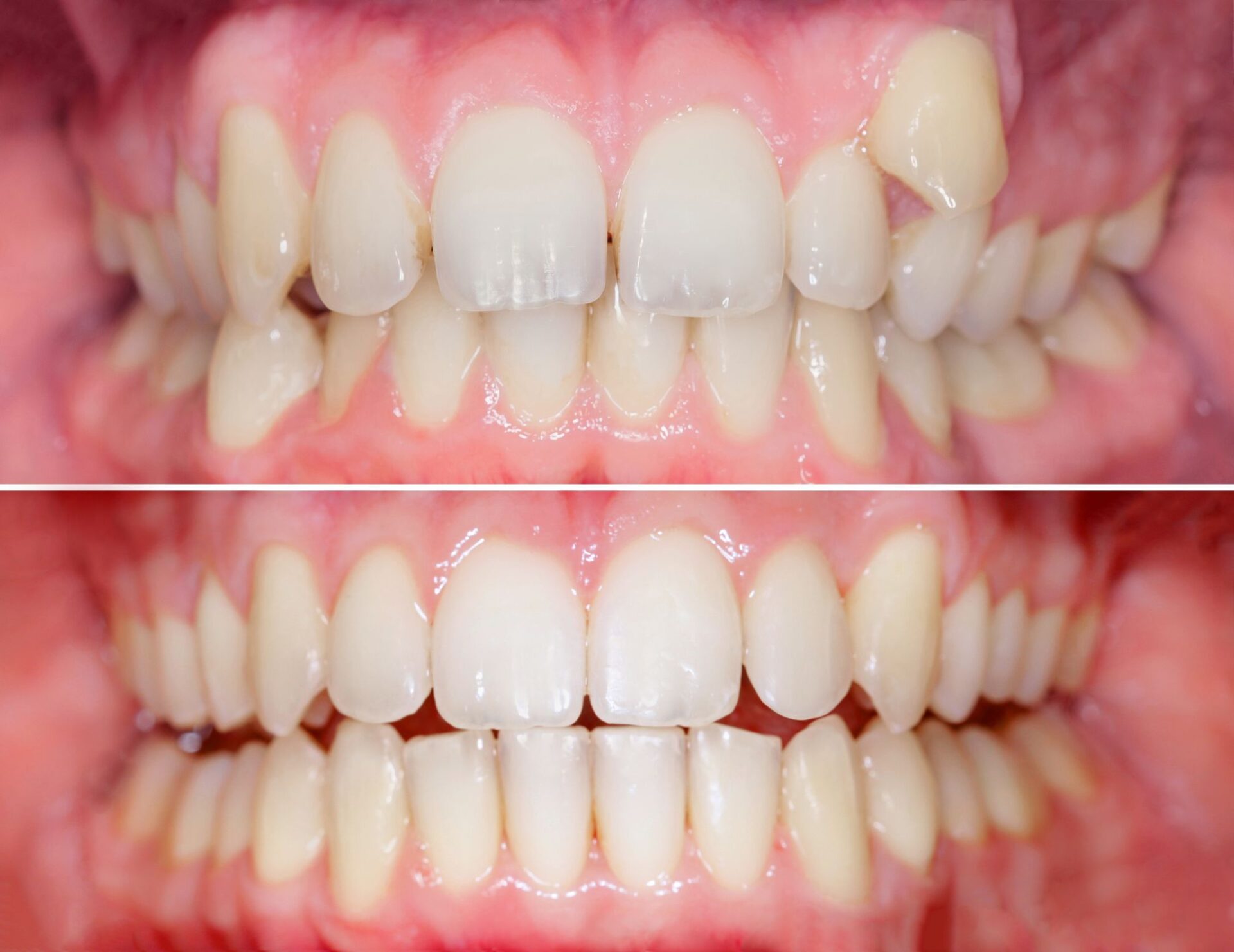 歯列矯正が早く終わる人の特徴とは？治療期間を早く終わらせるポイントも紹介