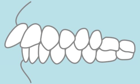 矯正のゴムかけの効果とは？出っ歯にも効く？痛い？治療期間についても解説 | 矯正歯科ピュアリオ