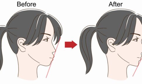 出っ歯の横顔を美人に！理想の横顔と歯列矯正の変化やおすすめの矯正治療方法を解説