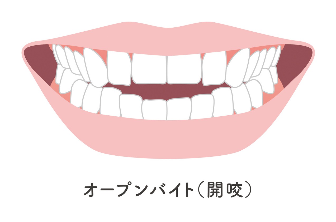 開咬とは?前歯が噛み合わない原因や危険性、治療法について解説します | 矯正歯科ピュアリオ