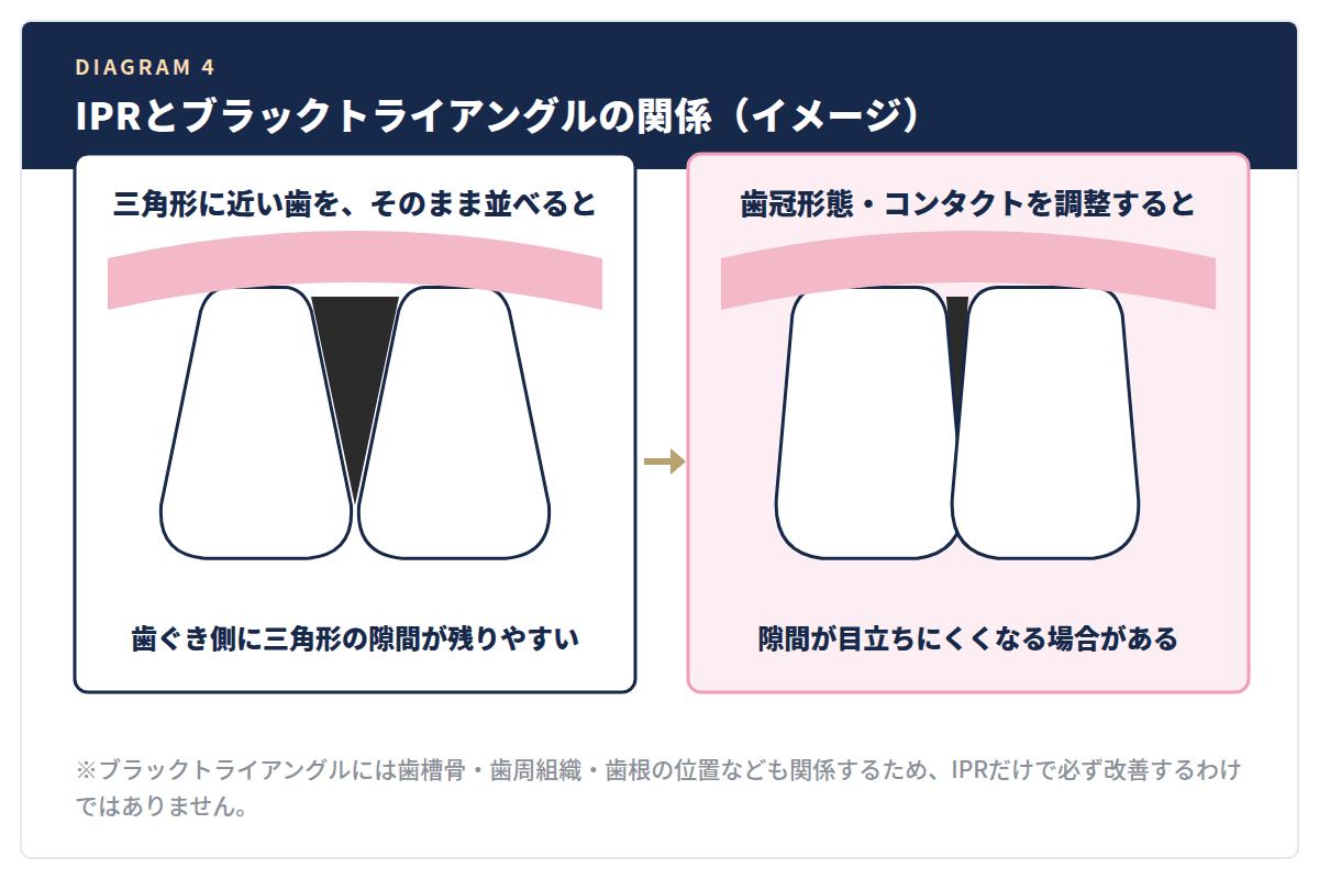 図解:三角形に近い歯をそのまま並べると歯ぐき側に隙間が残りやすく、歯冠形態やコンタクトを調整すると目立ちにくくなる場合がある